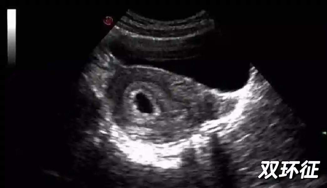 每天只学一点点 | 早孕期超声检查（1）