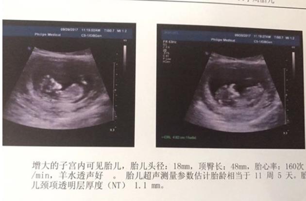 唐山供卵试管 2023在唐山市妇幼保健院做试管婴儿能保证选男胚女胚吗？ ‘怀女儿跟怀儿子b超区别’