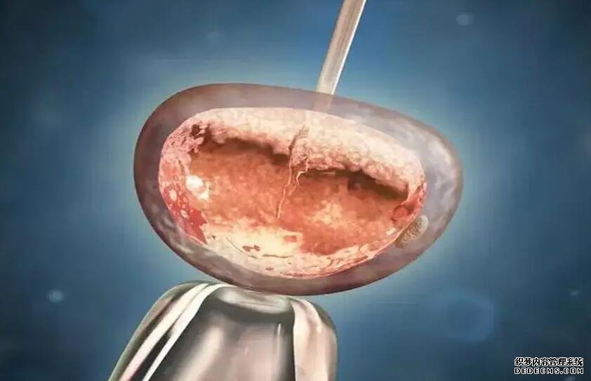 巧克力含有热量较高，产后宝妈一定要少吃