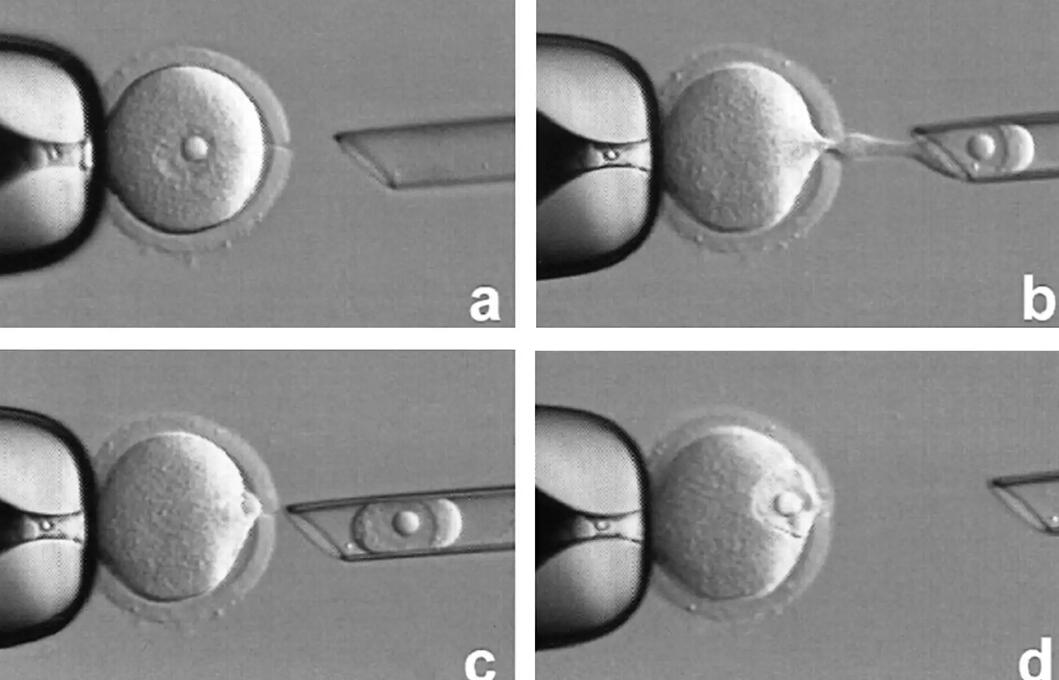 广州试管婴儿专家告诉你试管秘密了吗 广州何贤纪念医院做试管婴儿费用明细 ‘已生女孩的nt值真相居然是’