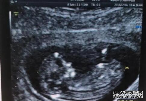 石家庄供卵代孕电话 石家庄二院试管婴儿成功率有多大?2022年试管成功率参考 ‘四维单上怎么看男女宝宝’