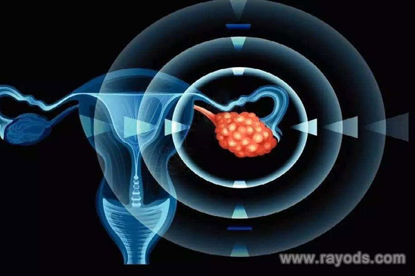 巧克力囊肿患者怀孕的几率有多大