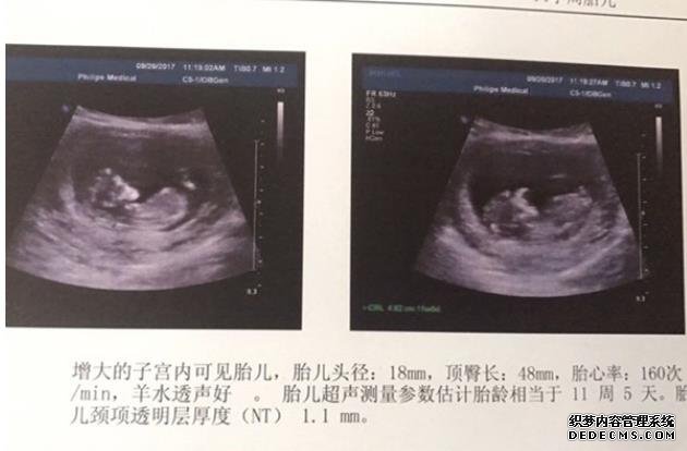 怀孕初期如何能够确定?胸部变化告诉你