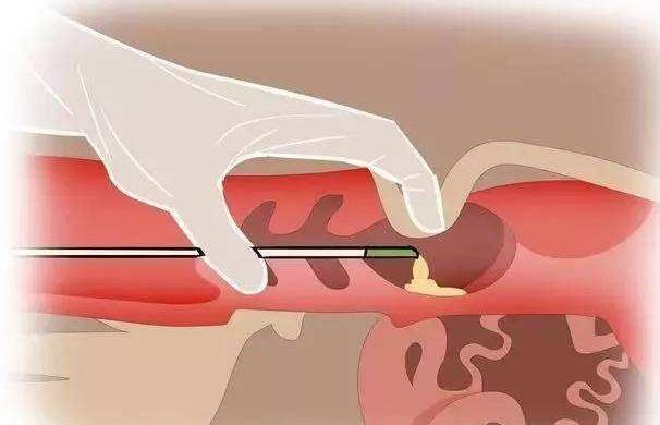 长沙湘雅医院做试管婴儿多少钱？每一代花销都不同