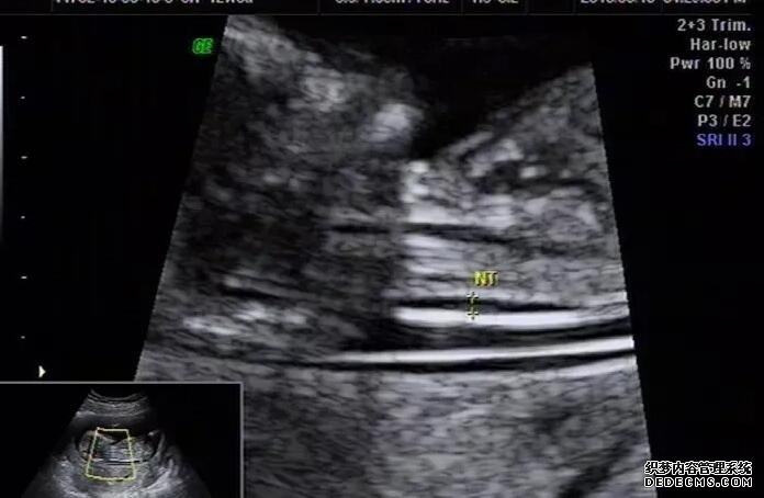 湛江附属医院试管成功率 湛江生殖医院二代试管费用 ‘50天孕囊大小可以看出男女吗’