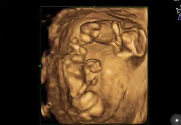 江苏试管供卵 江苏做试管包生男孩是真的吗? ‘孕妈妈总觉得自己怀的是男孩,怀孕症状又像女孩’