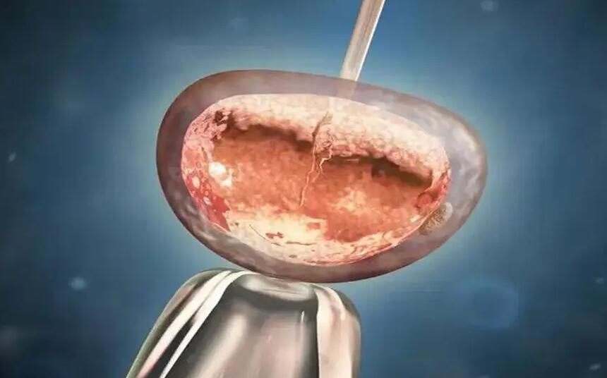 广东试管扶助 广东省中医院大学城医院做试管婴儿成功率有多少? ‘b超如何测男女’