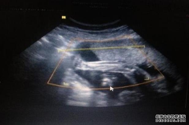 厦门求卵子 厦门医院试管是几代?厦门有可以做三代试管的医院吗? ‘孕囊9mm×6mm是男孩还是女孩’