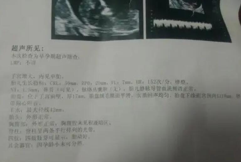 汕头阿尔法试管医院 汕头做试管婴儿可以选择男孩吗? ‘四维彩超生殖器男女区别图’