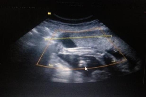 试管婴儿为什么在肚子上打针？怎么给自己打针？