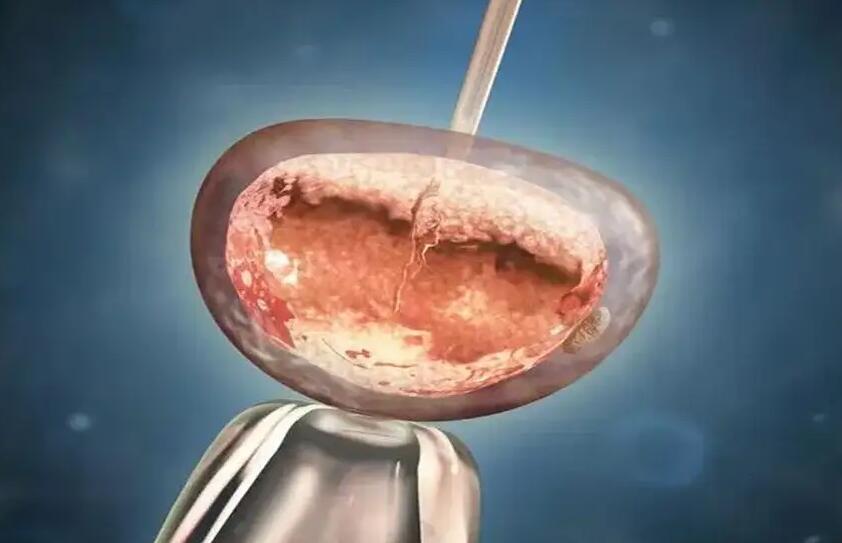 泰国试管婴儿真实经历试管婴儿要注重哪些环节？