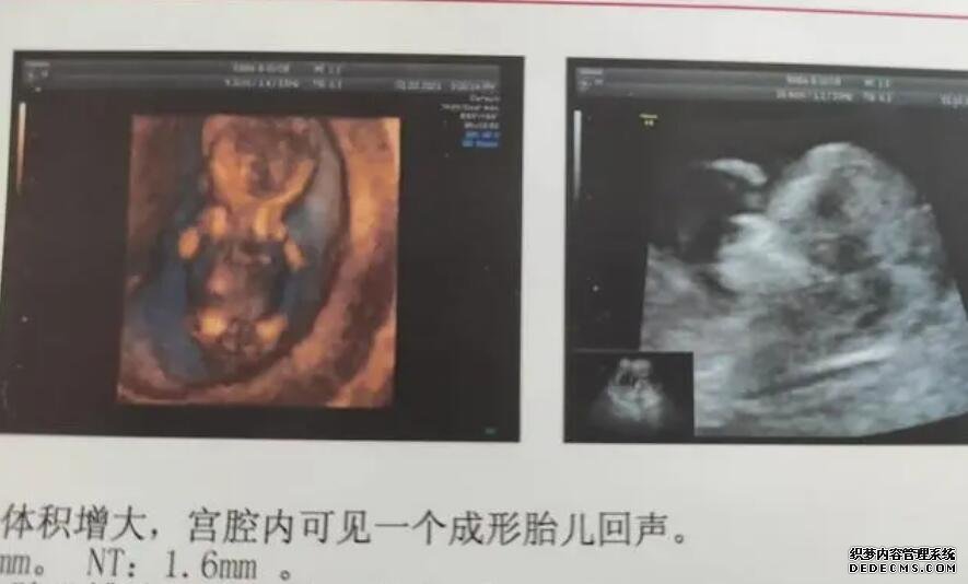 深圳代孕一次成功率 深圳试管医院推荐｜北京大学深圳医院 ‘孕囊27×25是男孩还是女孩?’