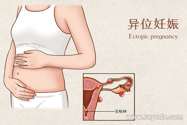 输卵管妊娠会降低以后怀孕几率