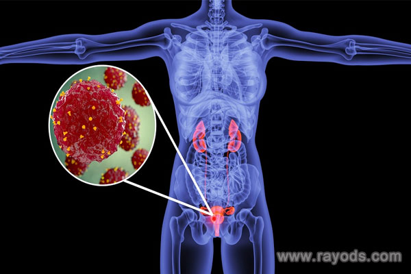 巧囊的最佳治疗时间为月经后