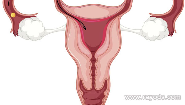 输卵管息肉会导致不孕