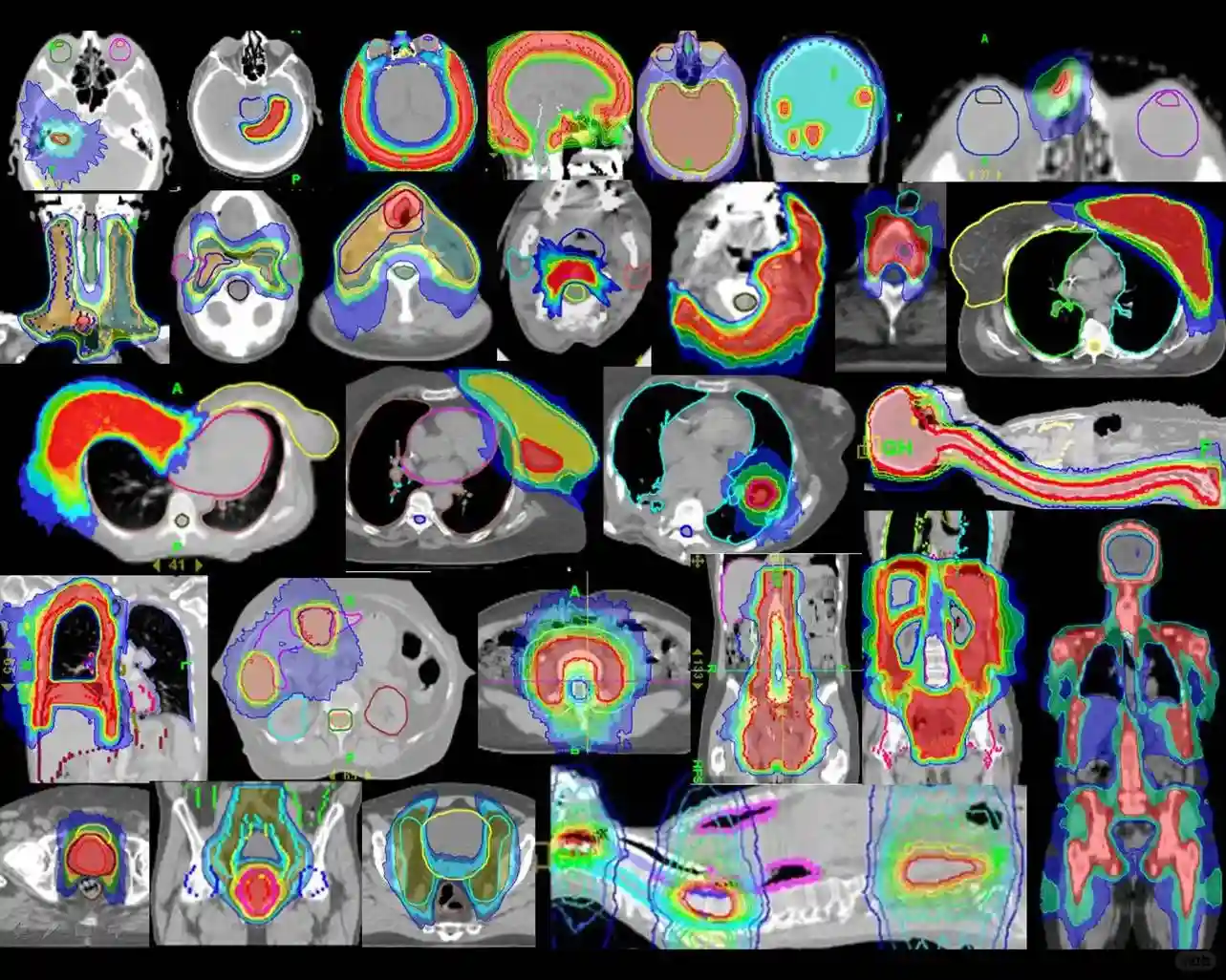 惊艳肿瘤界的技术-TOMO刀，又称托姆刀